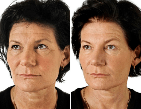 Az arc frakcionált megújulásának eredménye