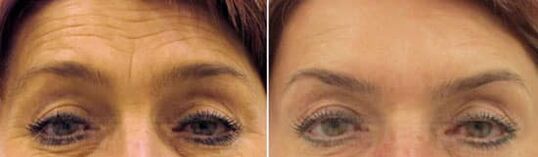 A homlok terepi megújulása