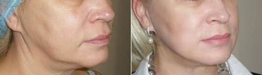 Fotó az eljárás alkalmazása után